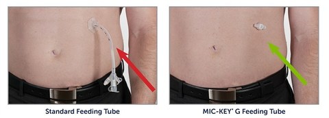 large_na_dh_mic-key_adult_standard_vs_mic-key_727x261.jpg